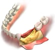 bone-regeneration-