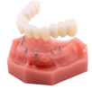 implant retained denture