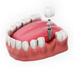 single-tooth-dental-implants-scaled-1