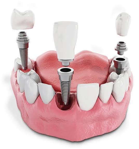 multiple implant placement
